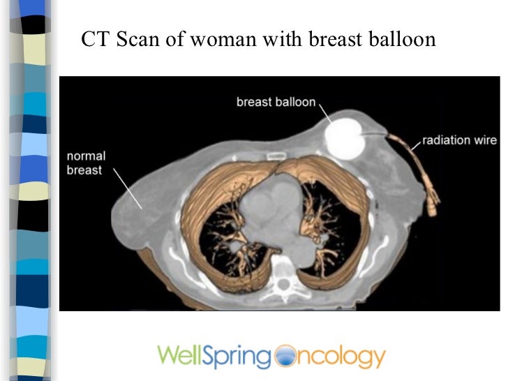 breast cancer cat scan Breast cancer cat scan